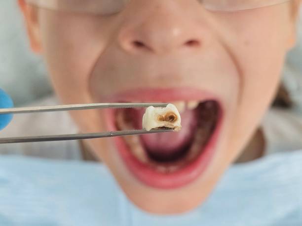Best Urgent Care for Lost Fillings or Crowns in Hershey, PA